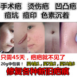 泰国喜疗疤20g 伤疤膏产品凹凸疤痕灵修复膏去手术祛烧伤痘坑疙瘩
