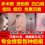 泰国祛去喜疗疤40g疤痕凹凸疤修复膏疤手术剖腹产伤烫膏孕妇 儿童