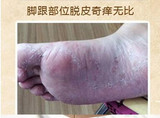 治脚气去除脚臭脚癣特效香港脚水泡脱皮脚痒糜烂草药包泡脚粉