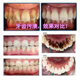 洗牙液牙齿美白白牙素速效美牙去黄牙烟渍牙渍洗牙水漂白洁白牙贴